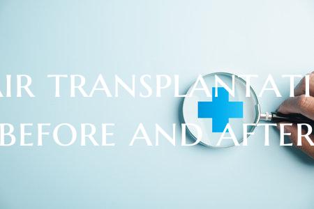 Hair transplantation before and after