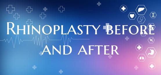 Rhinoplasty before and after